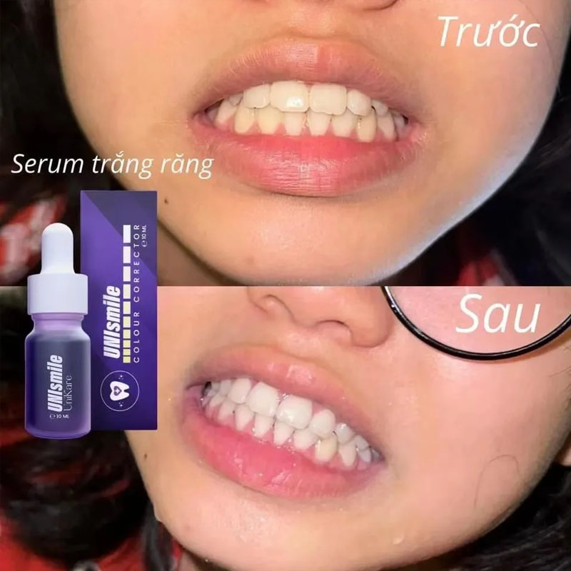 Essência de clareamento dental - Teeth Whitening Effective avaliação e preço