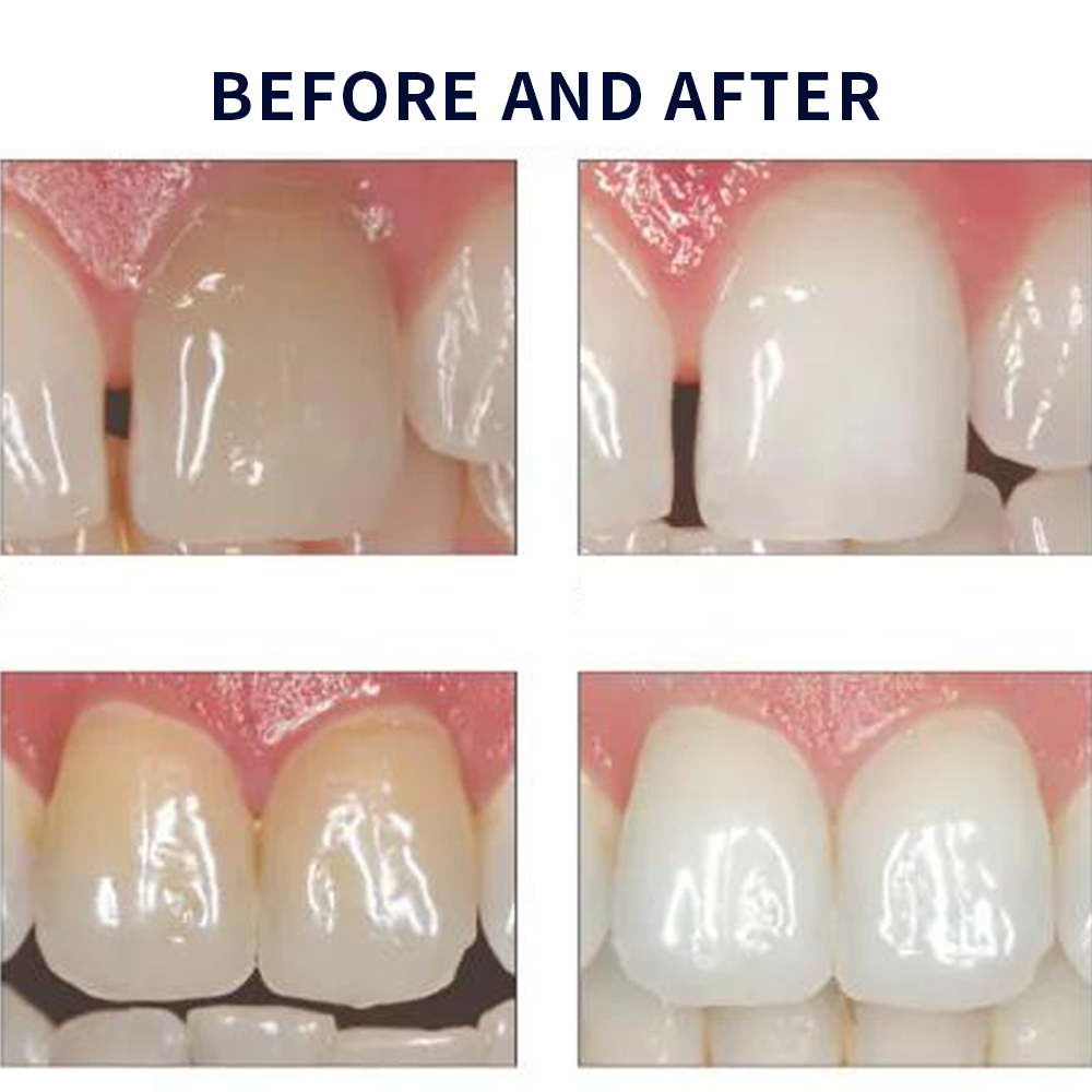 Opalescência Whitening Gel Kit - Teeth Whitening Bleaching Kit avaliação e preço