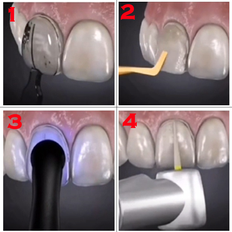 Molde Odontológico para Resina - Teeth Whitening Lab avaliação e preço