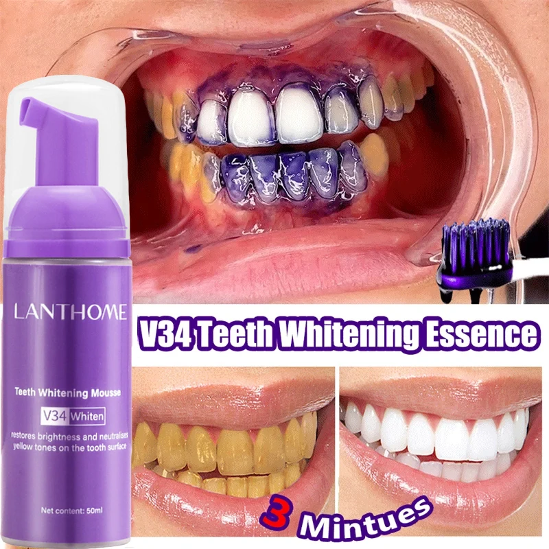 V34 dentes branqueamento mouss - Teeth Whitening (Bleaching) avaliação e preço