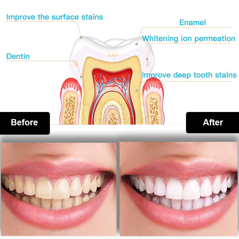 Kit de clareamento dental dos  - Teeth Whitening Bleaching Kit avaliação e preço